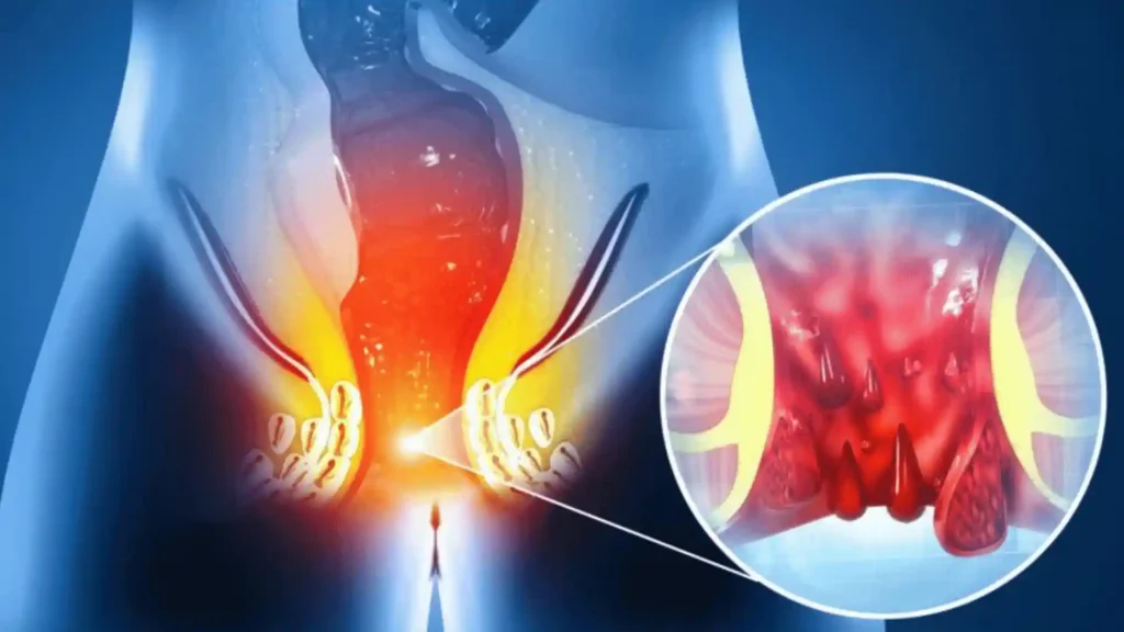 Piles vs Fissure vs Fistula best homepathy hospital in kerala
