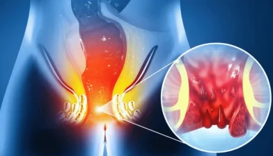 Piles vs Fissure vs Fistula best homepathy hospital in kerala