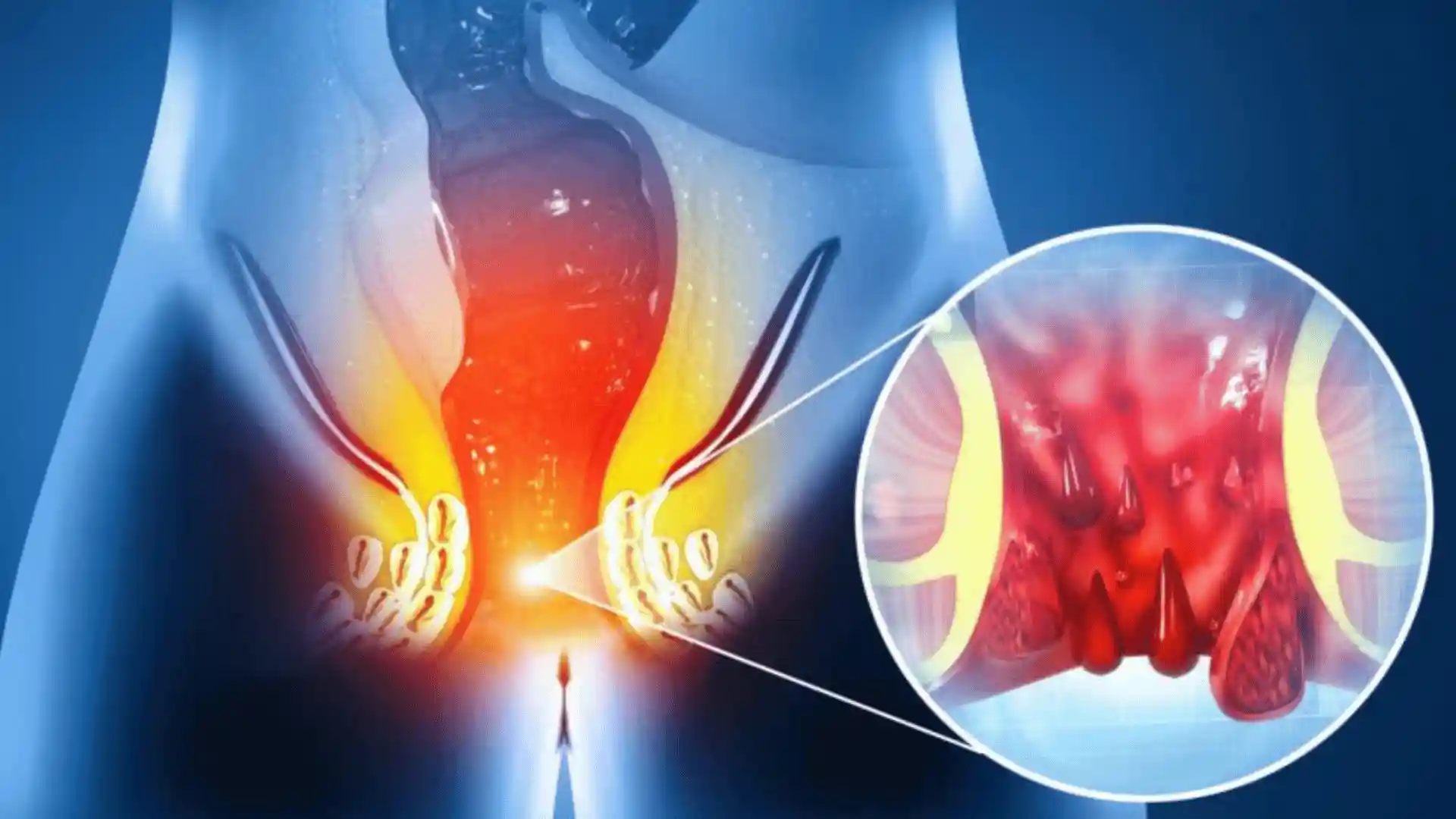 Piles vs Fissure vs Fistula best homepathy hospital in kerala