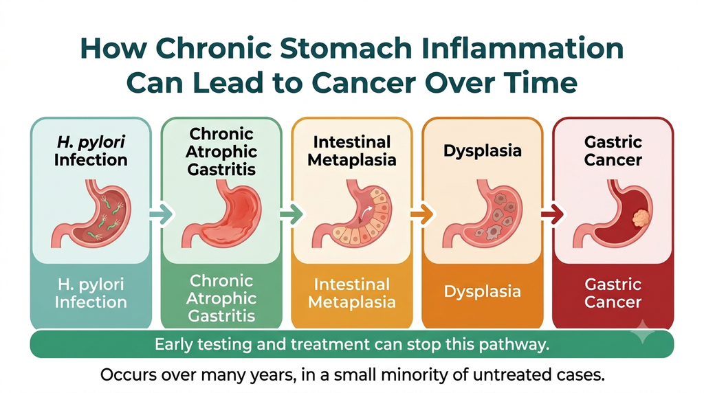Stomach ulcer cancer progression from H. pylori infection to gastric cancer
